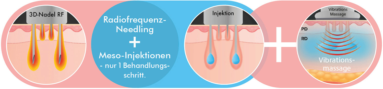Radiofrequenz Needling